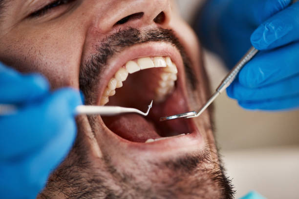 Best Emergency Wisdom Teeth Removal in Geneva, IL